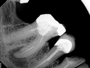 Broken Instrument Removal, Before and After Treatment