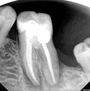 Infected molar, Before and After Treatment