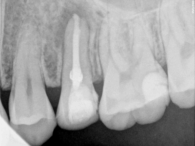 MTA Before and After Treatment