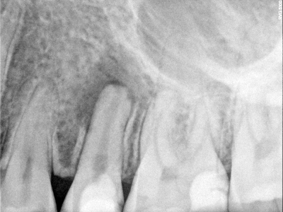 MTA Before and After Treatment