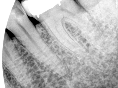 Sclerosis Canals, Before and After Treatment